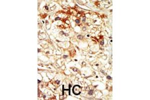 Formalin-fixed and paraffin-embedded human hepatocellular carcinoma tissue reacted with PCTK2 polyclonal antibody  , which was peroxidase-conjugated to the secondary antibody, followed by DAB staining. (CDK17 Antikörper  (N-Term))