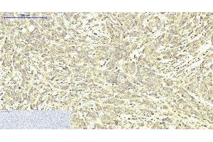 Immunohistochemistry of paraffin-embedded Human breast cancer tissue using ABCB5 Monoclonal Antibody at dilution of 1:200. (ABCB5 Antikörper)