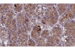 ABIN6273984 at 1/100 staining Human liver cancer tissue by IHC-P. (OR2V1 Antikörper  (Internal Region))