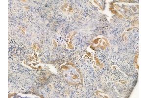 ABIN6260953 and ABIN6266991 at 1/100 staining human lung adenocarcinoma by IHC-P.