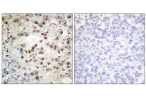Immunohistochemistry analysis of paraffin-embedded human breast carcinoma tissue using USF2 antibody. (USF2 Antikörper  (Internal Region))