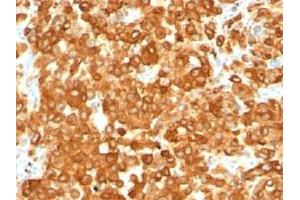 IHC staining of human melanoma with gp100 antibody (HMB45). (Melanoma gp100 Antikörper)