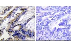 Immunohistochemistry analysis of paraffin-embedded human colon carcinoma tissue, using ILKAP Antibody. (ILKAP Antikörper  (AA 41-90))