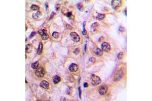 Immunohistochemical analysis of MST1/2 (pT183) staining in human breast cancer formalin fixed paraffin embedded tissue section. (MST1/MST2 (pSer183) Antikörper)