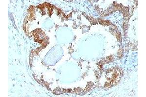 IHC testing of FFPE human prostate carcinoma and HSP27 antibody. (HSP27 Antikörper)