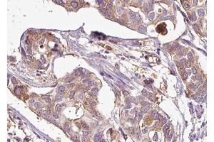 ABIN6267685 at 1/100 staining human Breast cancer tissue sections by IHC-P. (ASK1 Antikörper  (pSer83))