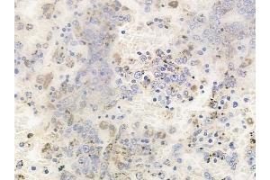 ABIN6256779 and ABIN6267619 at 1/100 staining human melanoma by IHC-P. (PKC delta Antikörper  (pTyr64))