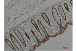 Immunohistochemistry (IHC) analysis of paraffin-embedded Human Colon Carcicnoma using HSP90 alpha Mouse Monoclonal Antibody diluted at 1:200. (HSP90AA2 Antikörper)