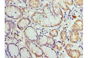 Immunohistochemistry of paraffin-embedded human gastric cancer using ABIN7155429 at dilution of 1: 100 (HIST2H3A Antikörper  (AA 108-136))
