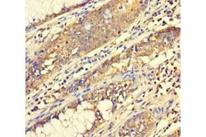 Immunohistochemistry of paraffin-embedded human colon cancer using ABIN7165014 at dilution of 1:100 (ABHD18 Antikörper  (AA 25-414))