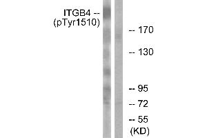Immunohistochemistry analysis of paraffin-embedded human breast carcinoma tissue using ITGB4 (Phospho-Tyr1510) antibody. (Integrin beta 4 Antikörper  (pTyr1510))