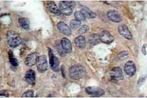 Immunohistochemistry (IHC) analyzes of p-c-Src antibody in paraffin-embedded human breast carcinoma tissue. (NCOA1 Antikörper  (pTyr529))