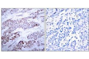 Immunohistochemical analysis of paraffin-embedded human breast carcinoma tissue using ATF4(Phospho-Ser245) Antibody(left) or the same antibody preincubated with blocking peptide(right). (ATF4 Antikörper  (pSer245))