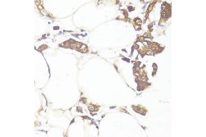 Immunohistochemistry of paraffin-embedded human breast cancer using Smad7 antibody (ABIN7270356) at dilution of 1:100 (40x lens).