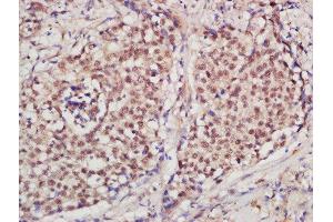 Formalin-fixed and paraffin embedded human laryngeal carcinoma  labeled with Rabbit Anti-PCNA [Proliferation Marker] Polyclonal Antibody (ABIN676598) at 1:200 followed by conjugation to the secondary antibody and DAB staining