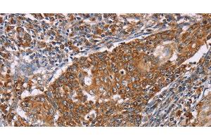Immunohistochemistry of paraffin-embedded Human cervical cancer tissue using PMPCB Polyclonal Antibody at dilution 1:50 (PMPCB Antikörper)