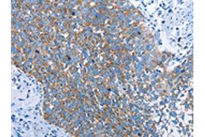 The image on the left is immunohistochemistry of paraffin-embedded Human cervical cancer tissue using ABIN7129698(HINT2 Antibody) at dilution 1/40, on the right is treated with fusion protein. (HINT2 Antikörper)