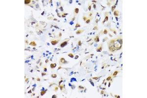 Immunohistochemistry of paraffin-embedded human lung cancer using EP300 antibody (ABIN6127823, ABIN6140193, ABIN6140194 and ABIN6216844) at dilution of 1:100 (40x lens). (p300 Antikörper  (AA 1-270))