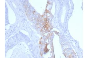 Formalin-fixed, paraffin-embedded human Colon Carcinoma stained with Cytokeratin 20 Mouse Monoclonal Antibody (KRT20/3145). (KRT20 Antikörper  (AA 196-323))