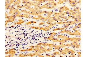 IHC image of ABIN7170921 diluted at 1:400 and staining in paraffin-embedded human liver cancer performed on a Leica BondTM system. (ALDH5A1 Antikörper  (AA 48-535))