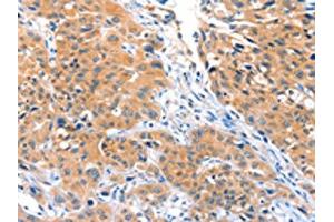 The image on the left is immunohistochemistry of paraffin-embedded Human lung cancer tissue using ABIN7128174(ACOX3 Antibody) at dilution 1/25, on the right is treated with fusion protein. (ACOX3 Antikörper)