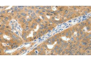 Immunohistochemistry of paraffin-embedded Human ovarian cancer tissue using SCN9A Polyclonal Antibody at dilution 1:40 (SCN9A Antikörper)