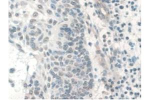 IHC-P analysis of Human Skin Cancer Tissue, with DAB staining. (COQ6 Antikörper  (AA 1-468))