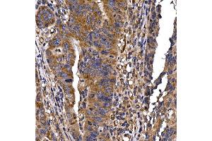 Immunohistochemistry of paraffin-embedded human colon carcinoma using DYNC1LI2 Rabbit pAb (ABIN7266863) at dilution of 1:25 (40x lens). (DYNC1LI2 Antikörper)