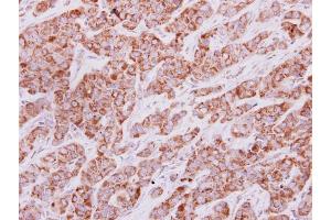IHC-P Image IDH3G antibody detects IDH3G protein at cytoplasm on human lung carcinoma by immunohistochemical analysis. (IDH3G Antikörper)