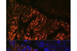 Immunofluorescence analysis of Human lung cancer cells using SCNN1A Polyclonal Antibody at dilution of 1:100. (SCNN1A Antikörper)