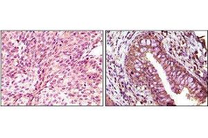Immunohistochemical analysis of paraffin-embedded human bladder carcinoma (left) and return carcinoma (right) tissue, showing cytoplasmic localization using EphB6 mouse mAb with DAB staining. (EPH Receptor B6 Antikörper)