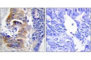 Immunohistochemistry analysis of paraffin-embedded human colon carcinoma tissue, using CDCA3 Antibody. (CDCA3 Antikörper  (AA 219-268))