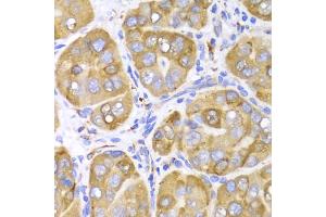 Immunohistochemistry of paraffin-embedded human liver cancer using LRPAP1 Antibody (ABIN5971543) at dilution of 1/100 (40x lens). (LRPAP1 Antikörper)