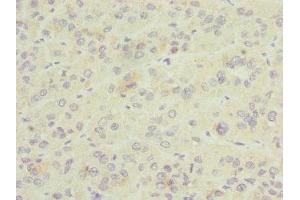 Immunohistochemistry of paraffin-embedded human liver cancer using ABIN7153581 at dilution of 1:100 (GDAP1 Antikörper  (AA 1-225))