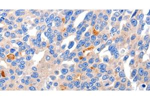 Immunohistochemistry of paraffin-embedded Human liver cancer tissue using KCNH8 Polyclonal Antibody at dilution 1:50 (KCNH8 Antikörper)
