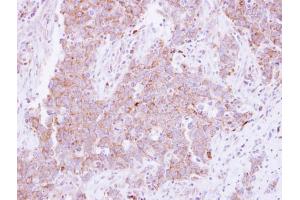 IHC-P Image Immunohistochemical analysis of paraffin-embedded human lung Papillary adenocarcinoma, using CD81, antibody at 1:250 dilution. (CD81 Antikörper)