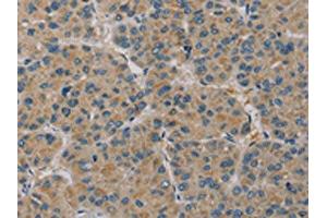 The image on the left is immunohistochemistry of paraffin-embedded Human liver cancer tissue using ABIN7130528(PAGE2 Antibody) at dilution 1/20, on the right is treated with fusion protein. (PAGE2 Antikörper)