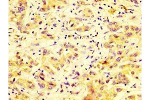 IHC image of ABIN7150786 diluted at 1:600 and staining in paraffin-embedded human liver cancer performed on a Leica BondTM system. (DUSP9 Antikörper  (AA 142-263))