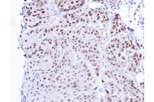 IHC-P Image Immunohistochemical analysis of paraffin-embedded Cal27 Xenograft, using TBLR1 , antibody at 1:100 dilution. (TBL1XR1 Antikörper)