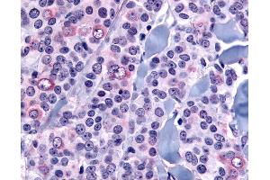 Anti-NANP antibody IHC of human Breast, Carcinoma. (NANP Antikörper  (Internal Region))
