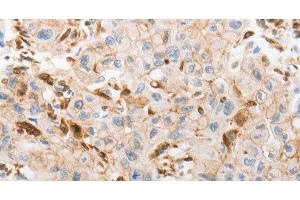 Immunohistochemistry of paraffin-embedded Human lung cancer tissue using SLC15A2 Polyclonal Antibody at dilution 1:60 (SLC15A2 Antikörper)