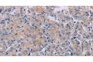 Immunohistochemistry of paraffin-embedded Human prostate cancer using P2RX3 Polyclonal Antibody at dilution of 1:50 (P2RX3 Antikörper)