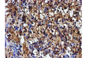 Immunohistochemical staining of paraffin-embedded Carcinoma of Human kidney tissue using anti-IDS mouse monoclonal antibody. (IDS Antikörper)