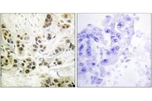 Immunohistochemistry analysis of paraffin-embedded human breast carcinoma, using Lamin A/C (Phospho-Ser392) Antibody.