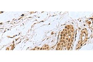 Immunohistochemistry of paraffin-embedded Human esophagus cancer tissue using WRNIP1 Polyclonal Antibody at dilution of 1:35(x200) (WRNIP1 Antikörper)