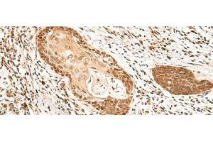 Immunohistochemistry of paraffin-embedded Human esophagus cancer tissue using MKX Polyclonal Antibody at dilution of 1:60(x200) (MKX Antikörper)