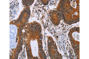Immunohistochemistry of Human lung cancer using IHH Polyclonal Antibody at dilution of 1:30 (Indian Hedgehog Antikörper)