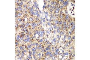 Immunohistochemistry of paraffin-embedded human lung cancer using SPARC antibody (ABIN5970787) at dilution of 1/100 (40x lens). (SPARC Antikörper)