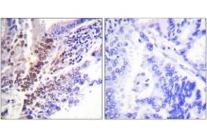Immunohistochemistry analysis of paraffin-embedded human lung carcinoma, using GR (Phospho-Ser226) Antibody. (GR (AA 201-250), (pSer226) Antikörper)