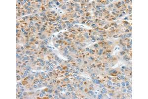 Immunohistochemical analysis of paraffin-embedded Human liver cancer tissue using at dilution 1/30. (Superoxide dismutase copper chaperone Antikörper  (C-Term))